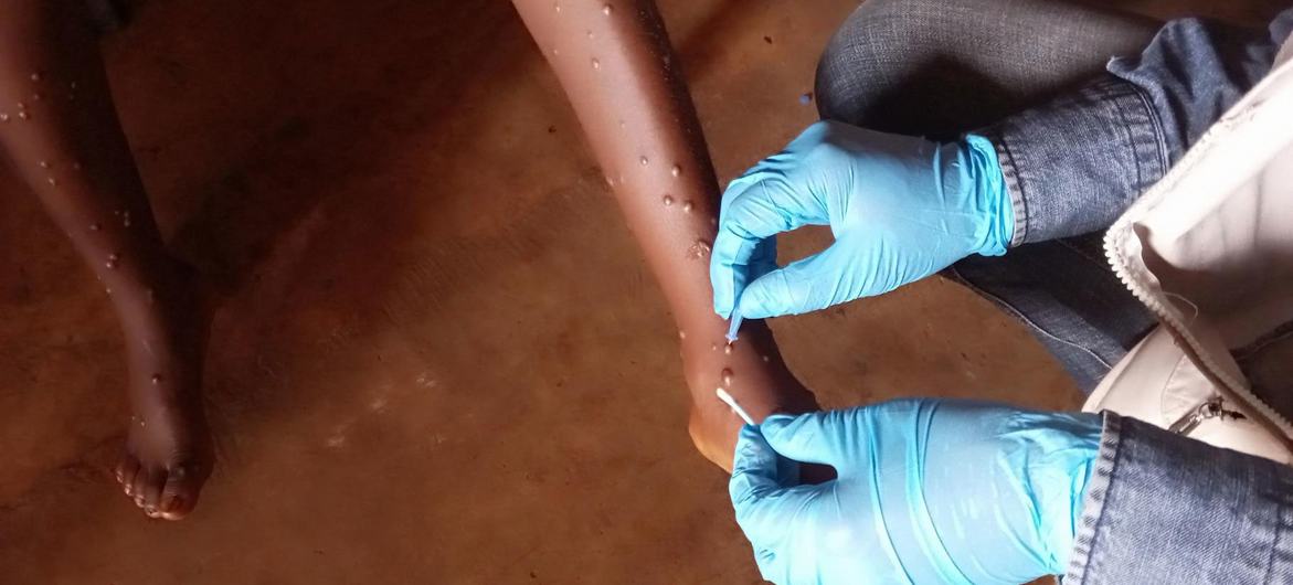 Mpox Emergency